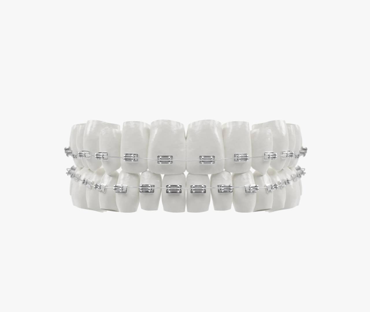 Metal Braces White Smile Dental