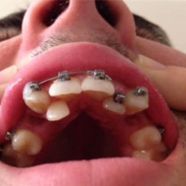 Braces Before And After Braces Before And After