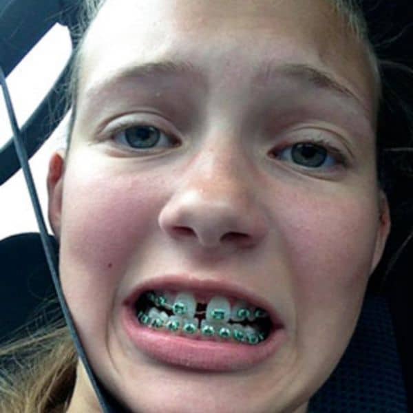 Braces Before And After Braces Before And After