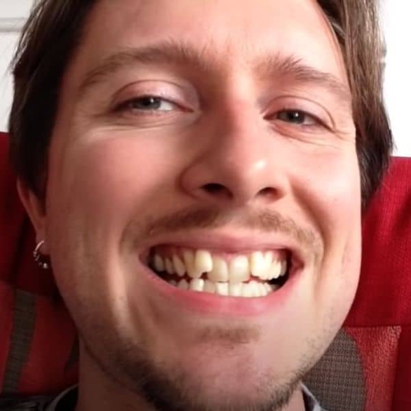 Invisalign Before And After