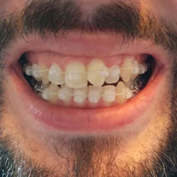 Braces Before And After Braces Before And After