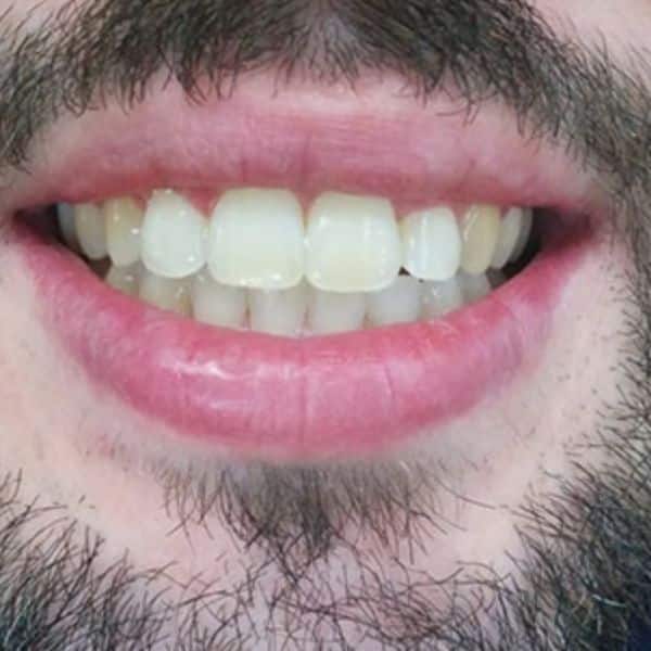 Braces Before And After Braces Before And After