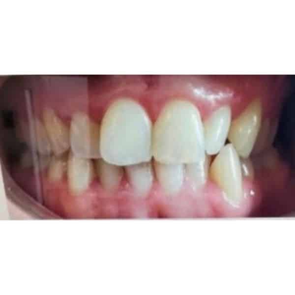 Braces Before And After Braces Before And After