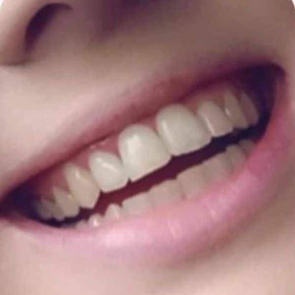 Braces Before And After Braces Before And After