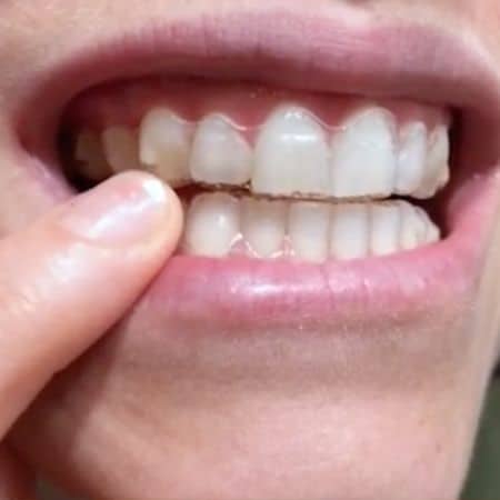 Invisalign Invisalign