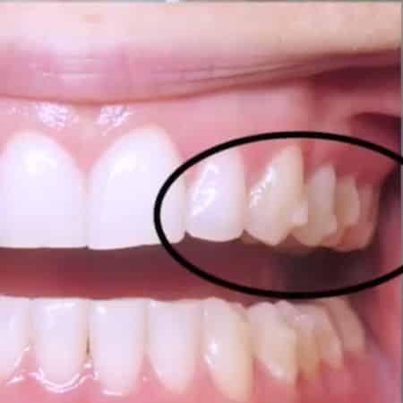 Invisalign Invisalign