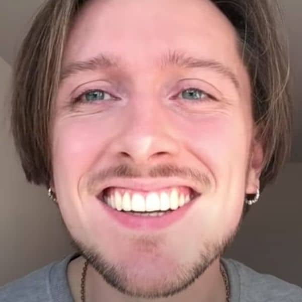 Invisalign Before And After