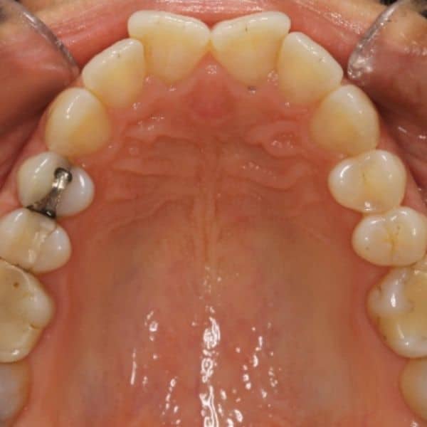 Invisalign Before And After