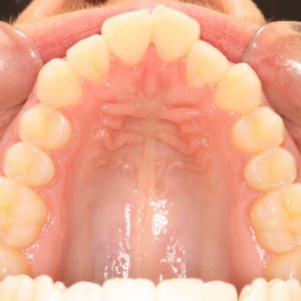 Invisalign Before And After