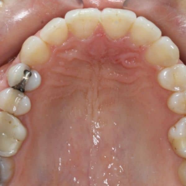 Invisalign Before And After