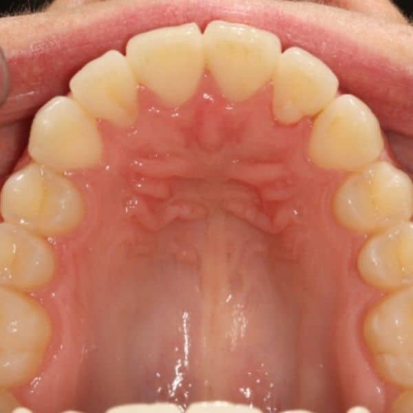 Invisalign Before And After