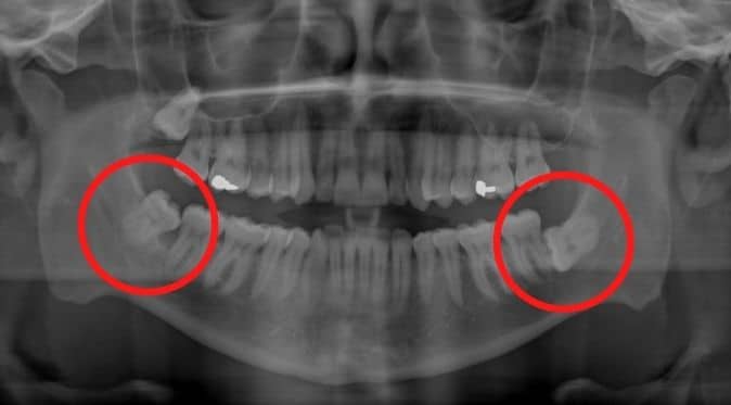Panoramic Xray invisalign dublin