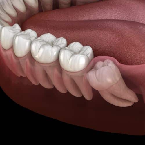 Wisdom Tooth Extraction