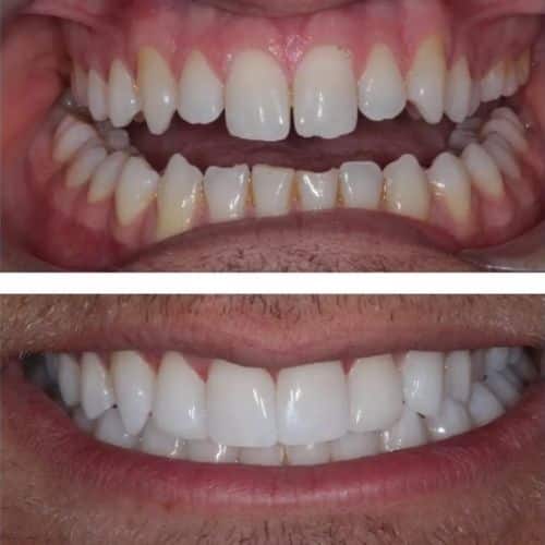 Composite Bonding Composite Bonding