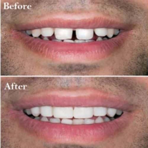 Composite Bonding Composite Bonding
