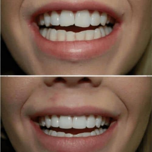 Composite Bonding Composite Bonding