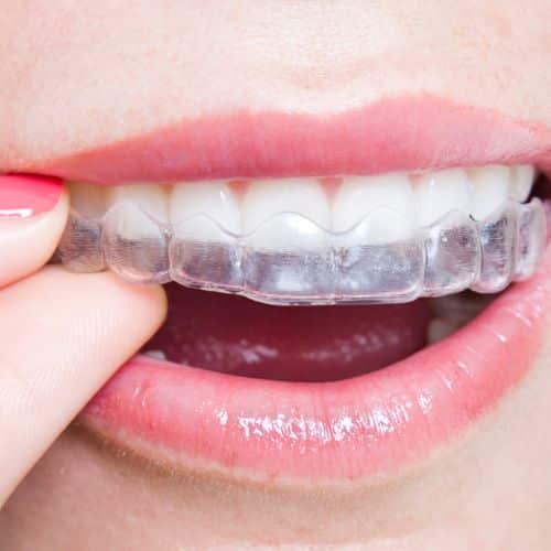 braces clear invisalign (500 × 500 px) braces clear