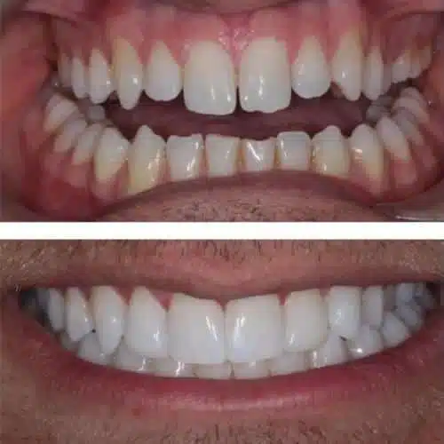Composite Bonding Before And After