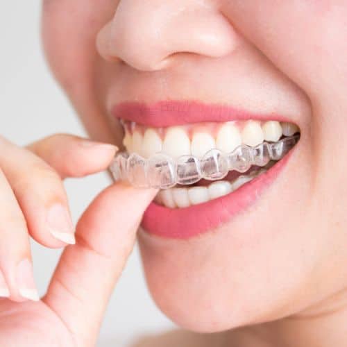 invisalign before and after Invisalign
