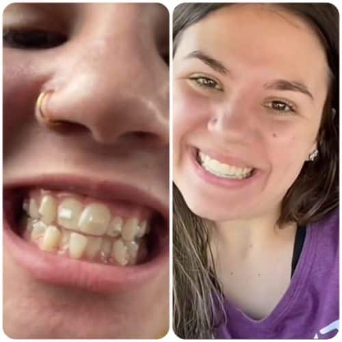 invisalign how much does Invisalign cost in dublin and cork