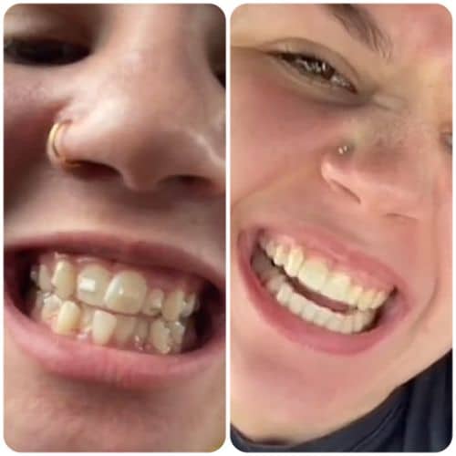 invisalign
