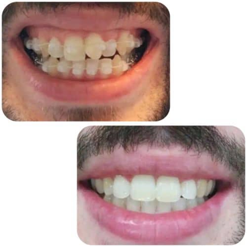 braces before and after Metal vs Ceramic Braces: Which Is Right for You?