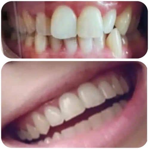 braces before and after