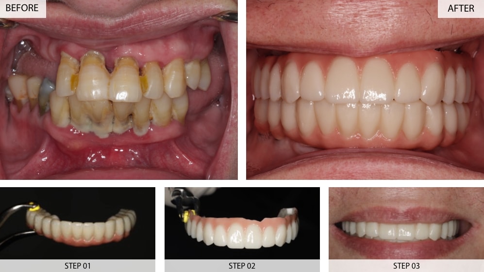 dental implants dental implants