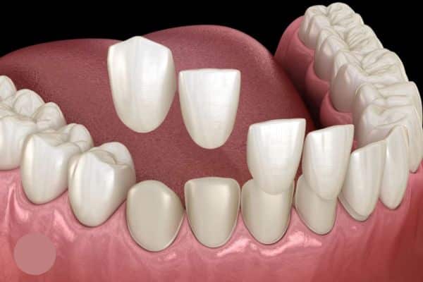 composite veneers composite veneers
