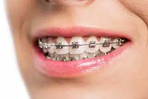 Untitled design Metal vs Ceramic Braces: Which Is Right for You?