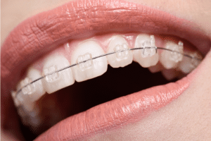 ceramic metal braces Metal vs Ceramic Braces: Which Is Right for You?