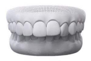 overbite
