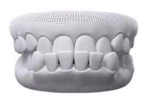 underbite