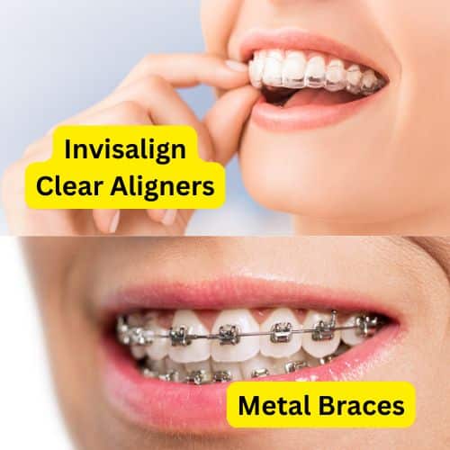 invisalign vs braces invisalign vs braces