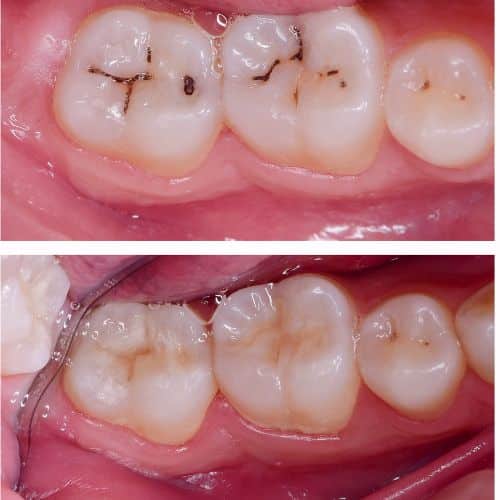 white fillings (1)