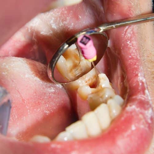 white fillings (3) fillings for teeth