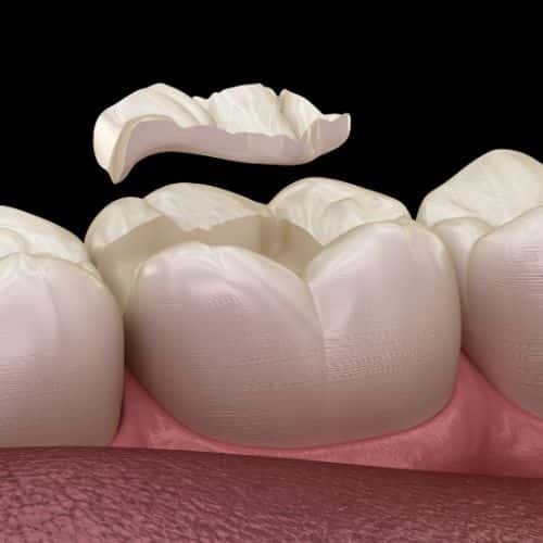 white fillings fillings for teeth