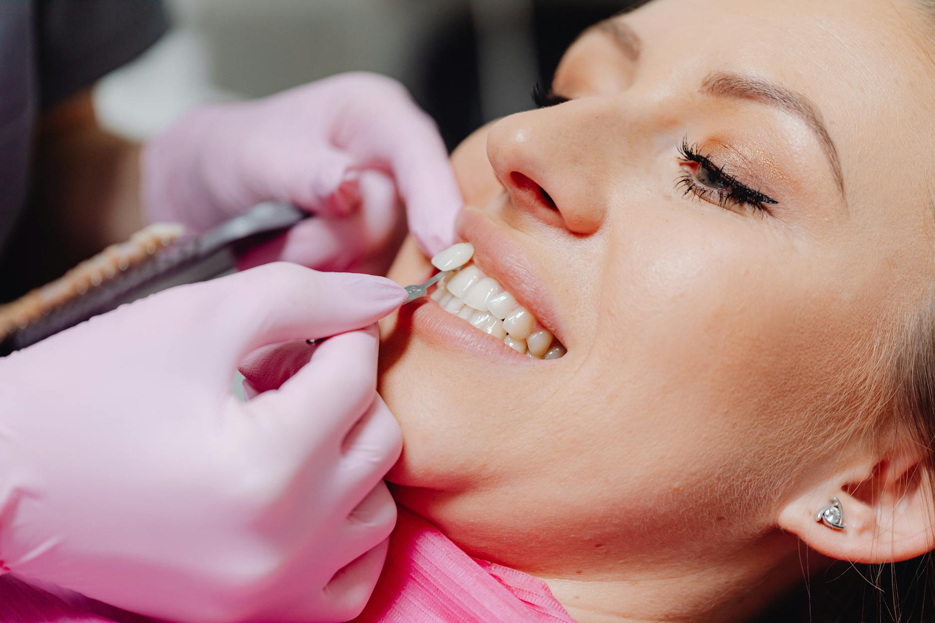 before and after smile transformation with dental veneers