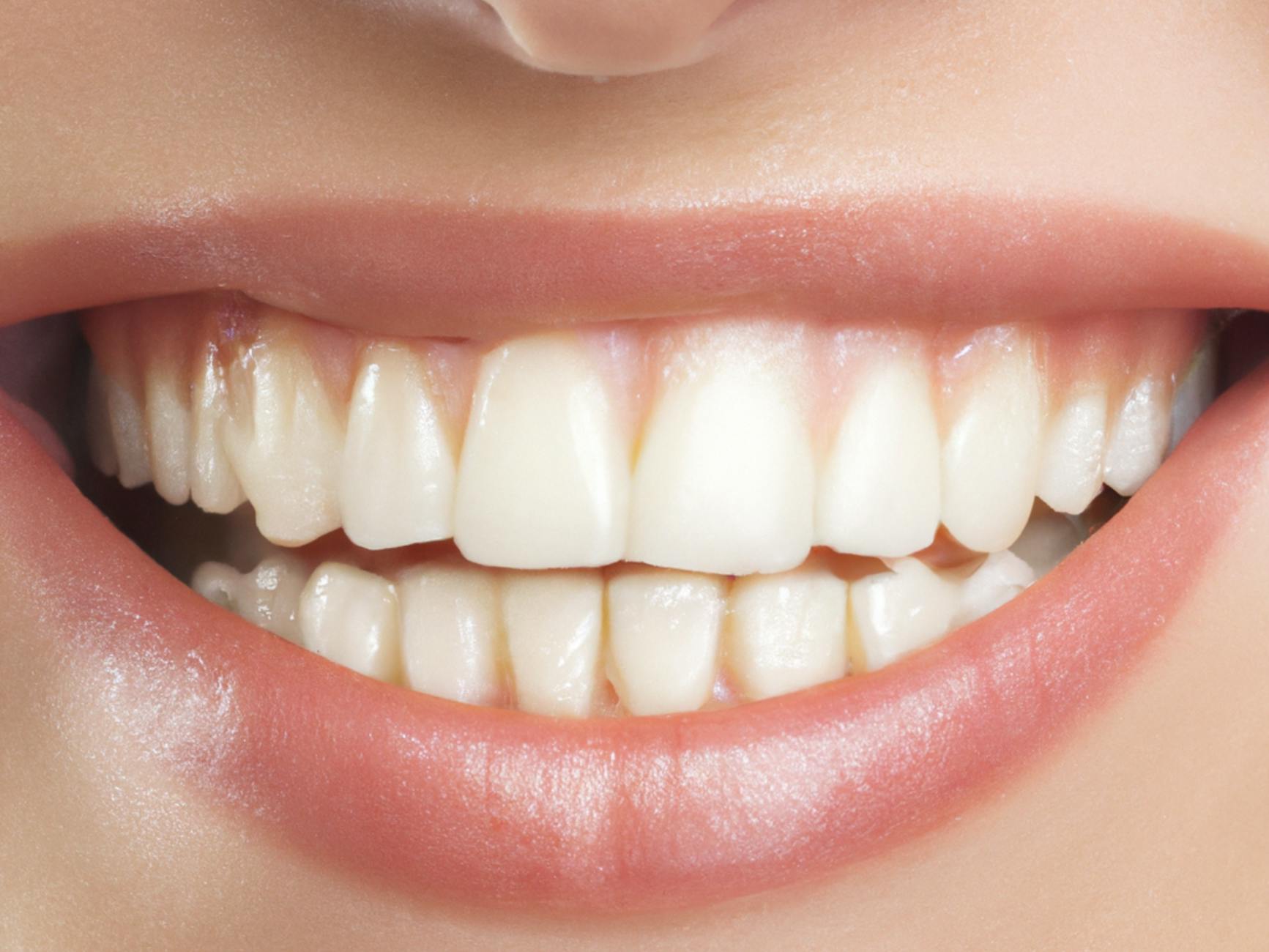 side by side comparison of composite bonding vs veneers results