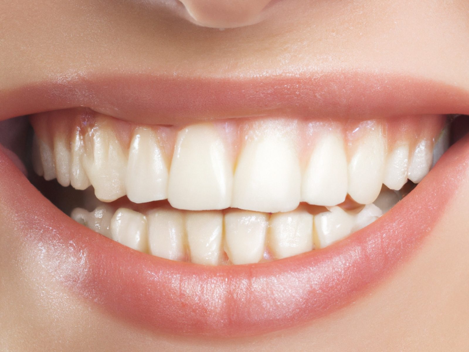 before and after composite bonding front teeth Dublin patient